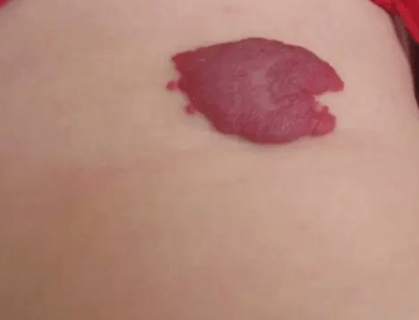 合肥协大皮肤病医院：婴儿血管瘤好治吗？
